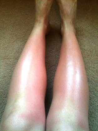 Burned legs